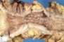 Crohn ileitis