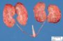 Bilateral non-obstructive renal dysplasia (BNORD) in Meckel (...)