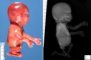 Caudal regression syndrome with lumbosacral agenesis
