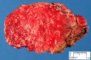 Hepatic granulomatosis in a systemic fungal infection