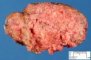 Hepatic granulomatosis in a systemic fungal infection