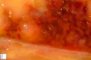 Hodgkin lymphoma invasion of the liver