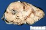 Intra-abdominal immature teratoma