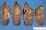 Xanthogranulomatous reaction aroud bronchiectases in cystic (...)