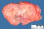 Invasive pulmonary aspergillosis