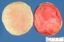 Subserosal uterine leiomyoma