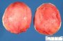 Subserosal uterine leiomyoma