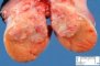 Testicular embryonal carcinoma