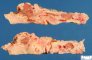 Acute necrotizing pancreatitis