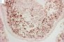 Botryoid embryonal rhabdomyosarcoma of the rhinopharynx (Myogenin)