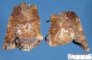 Bronchiectasis with peribronchial inflammation