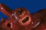 Dissection of the carotid artery. Credit: Webpath