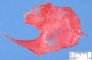 Left diaphragmatic hernia (fetus, 25 weeks)
