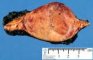 Adrenal pheochromocytoma (after formalin fixation)