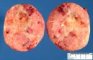 Aldosterone-secreting adrenocortical tumor