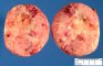 Aldosterone-secreting adrenocortical tumor