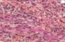 Vulvar embryonal rhabdomyosarcoma