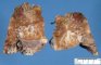 Bronchiectasis with peribronchial inflammation