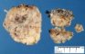 Cervical desmoid fibromatosis