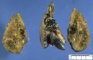 Dilatation of large bile ducts in extrahepatic biliary tract (...)