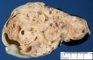 Intra-abdominal immature teratoma