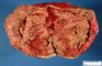 Necrotic subserosal uterine leiomyoma