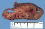 Congenital cystic adenomatoid malformation type IV. Macroscopy.