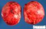 Aldosterone-secreting adrenocortical tumor
