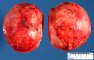 Aldosterone-secreting adrenocortical tumor