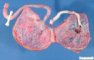 Placenta in diamniotic dichorionic twin pregnancy