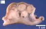 Gastric GIST