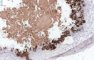 Positive immunochemistry for adenovirus in bronchus