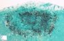 Candida adenitis in neutropenia