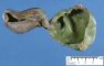 Choledochal cyst