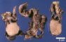 Gastric GIST