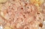 Pulmonary giant cystic chondroid hamartoma