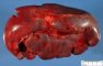 Splenomegaly in spherocytosis