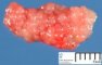 Vesical embryonal rhabdomyosarcoma