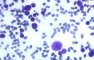 Parvovirus B19 cytopathogenic effect in bone marrow