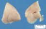 Quadrilobar left lung in trisomy 18 (20 weeks)