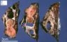 Bronchiectasis with mucocele