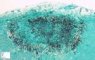 Candida adenitis in a neutropenic child.