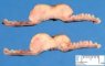 Intestinal Burkitt lymphoma
