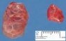 Megacystis, bilateral obstructive multicystic renal dysplasia (BOMRD) with (...)