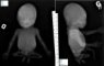 Caudal regression syndrome with lumbosacral agenesis and situs (...)