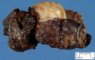 Hemorrhagic necrosis in adnexal torsion (hemorrhagic infarction)