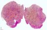 Intramuscular lobular capillary hemangioma
