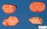 Nodal Castleman disease