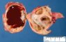 Ovarian endometriotic cyst