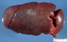 Splenomegaly in spherocytosis